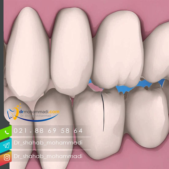 سندروم ترک دندان چیست